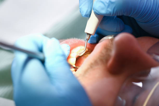 Best Emergency Tooth Extraction in Monroeville, OH