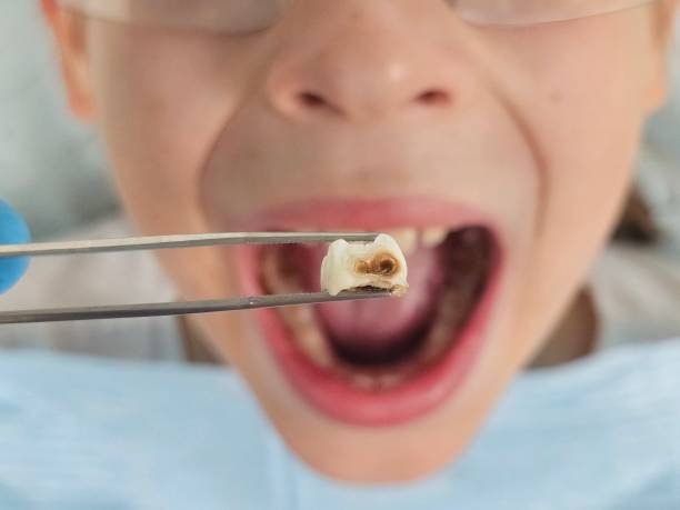 Best Emergency Tooth Extraction in Monroeville, OH
